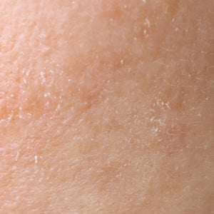Dry & Dehydrated Skin